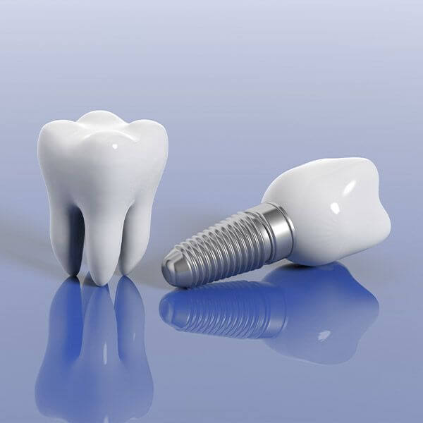 original_ImplantModel
