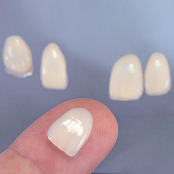 veneers7