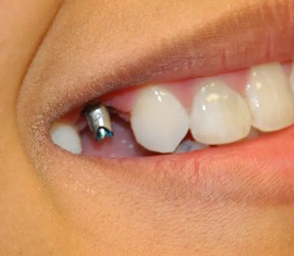 tooth extraction tampa