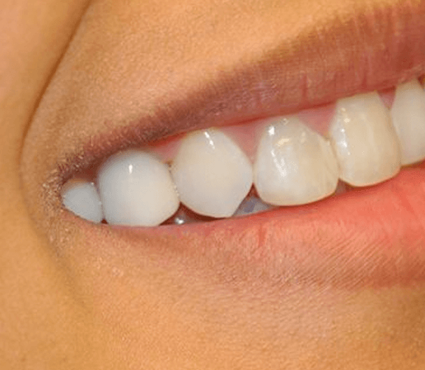 teeth whitening tampa