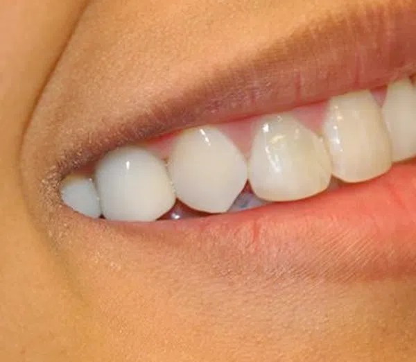 teeth whitening tampa