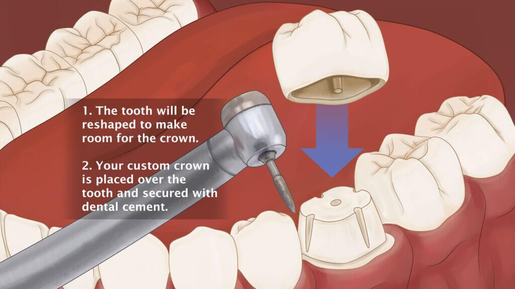 tooth extraction tampa
