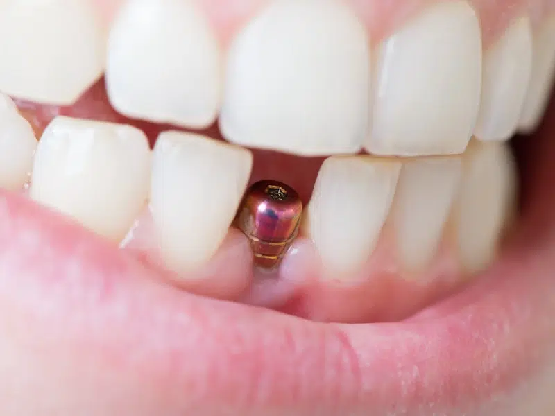 original_dental-implant