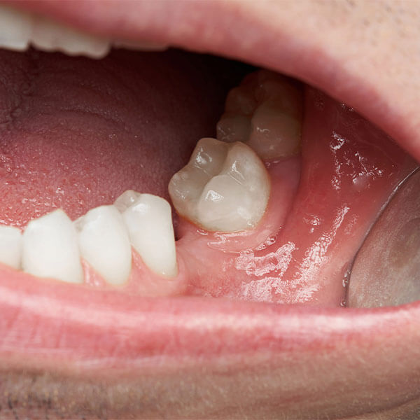 missingtooth
