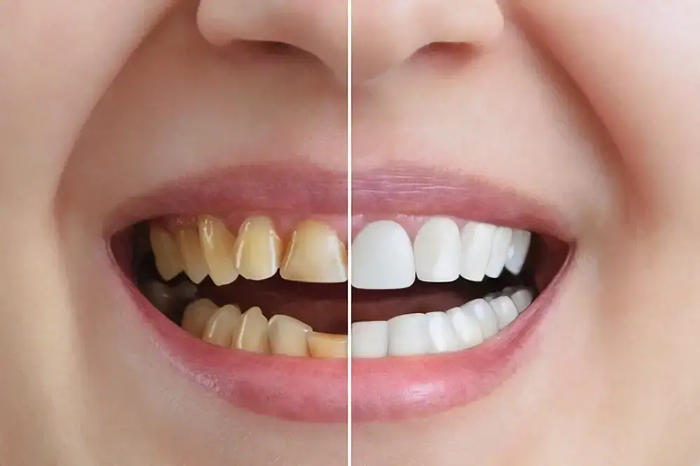 Teeth Bonding vs. Veneers