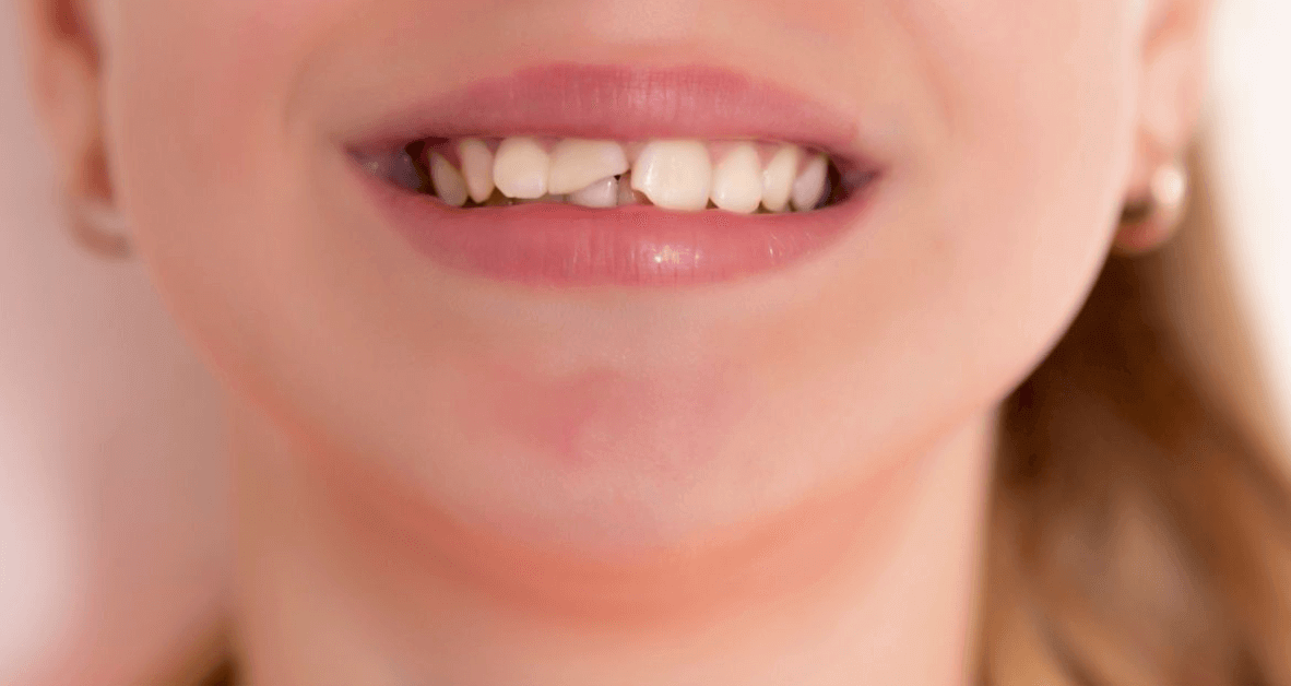 dental crown dental-crown