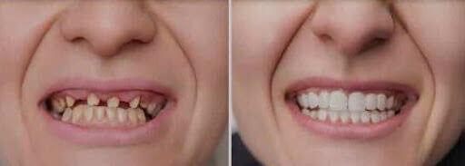 Full Mouth Reconstruction Full Mouth Reconstruction