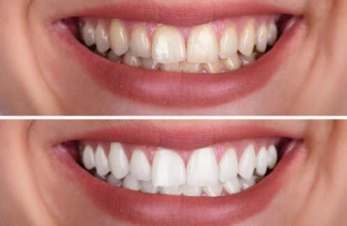 How to Restore Enamel on Teeth? How to Restore Enamel on Teeth?