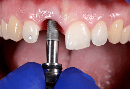 Dental Implants Versus Dentures: Which Choice Is Best? Dental Implants Versus Dentures: Which Choice Is Best?