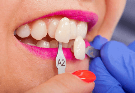 How Much Do Same-Day Crowns Cost in Westchase