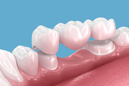 Dental Crowns vs. Veneers